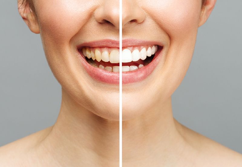 7 Reasons Teeth Whitening Is Most Popular Cosmetic Treatment