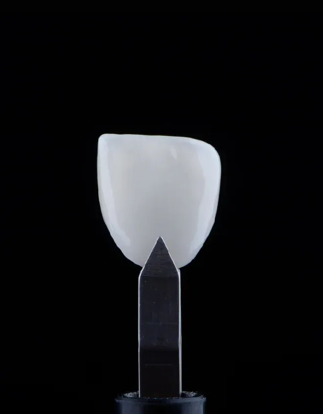 Dental Veneer and Their Role in Smile Enhancement