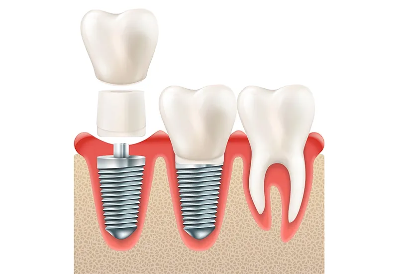 Dentures vs. Dental Implants: Pros, Cons, and Costs