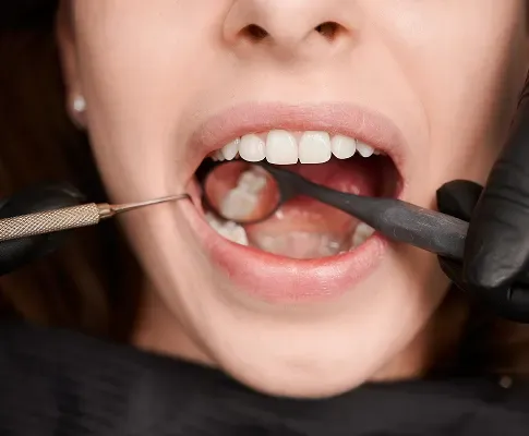 How Long Do Composite Fillings Last? 5 Signs You Might Need a Replacement