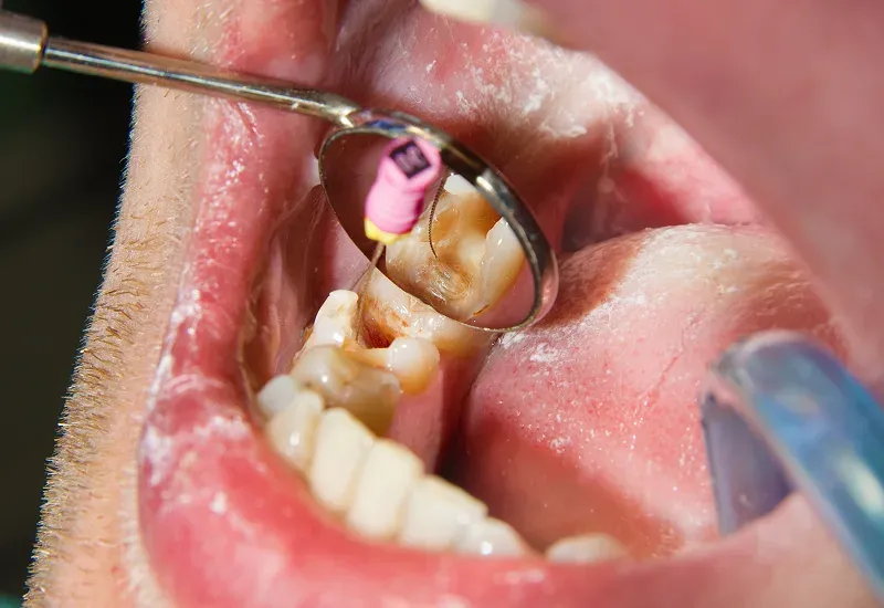 How Long Do Composite Fillings Last? 5 Signs You Might Need a Replacement